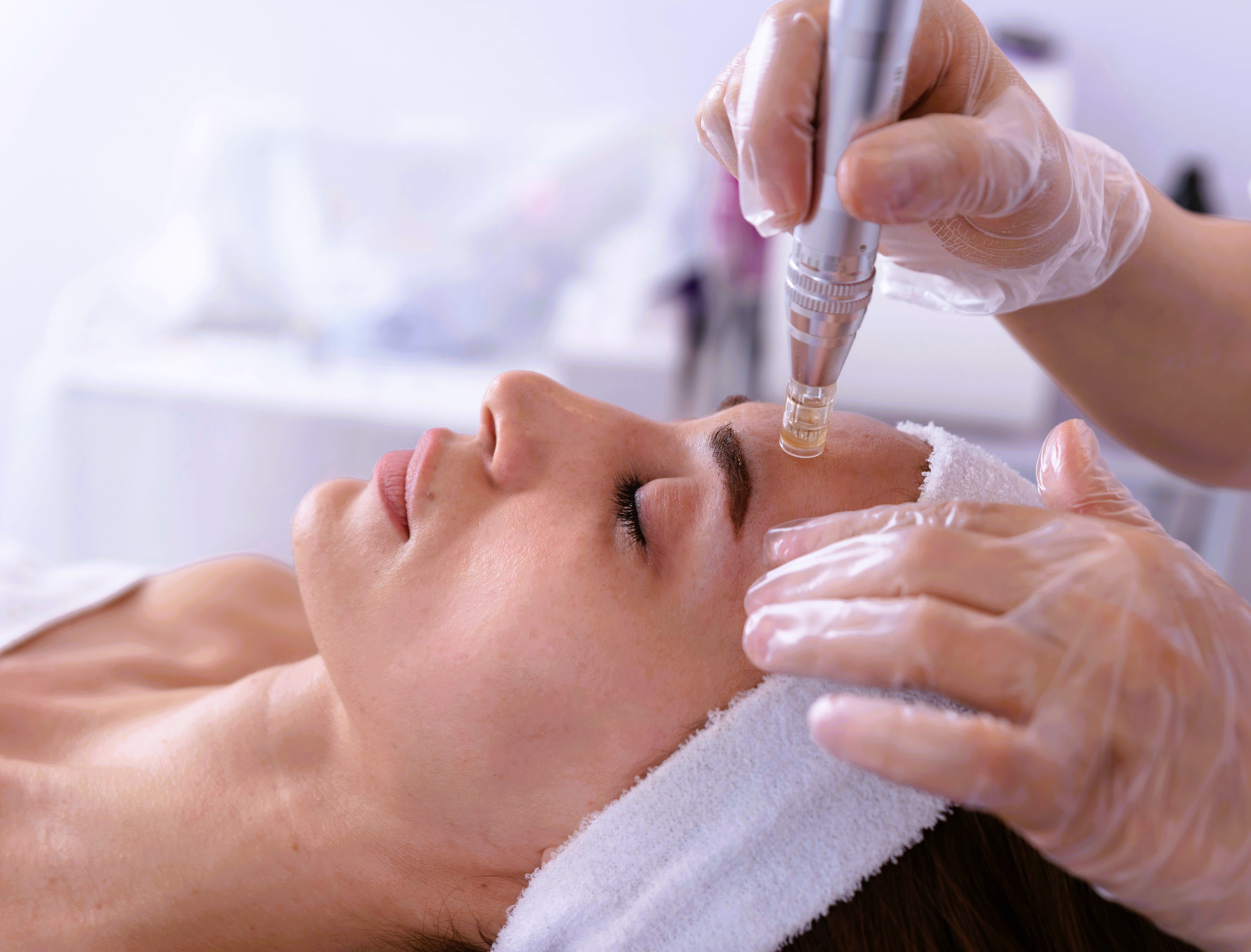 Microneedling